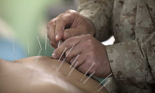 The Benefits of Acupuncture Therapy for Athletes